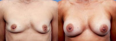 Breast Augmentation Before & After Gallery - Patient 58470477 - Image 1