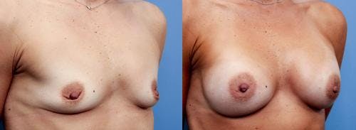 Breast Augmentation Before & After Gallery - Patient 58470477 - Image 2