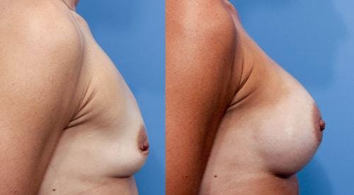 Breast Augmentation Before & After Gallery - Patient 58470477 - Image 3