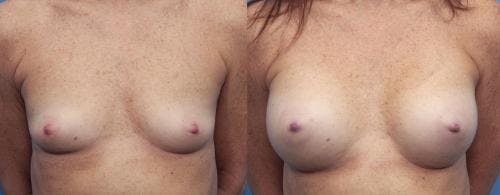 Breast Augmentation Before & After Gallery - Patient 58470478 - Image 1