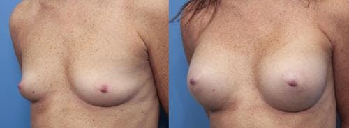 Breast Augmentation Before & After Gallery - Patient 58470478 - Image 2
