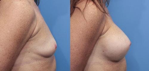 Breast Augmentation Before & After Gallery - Patient 58470478 - Image 3
