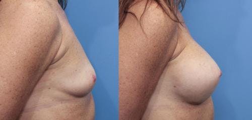 Breast Augmentation Before & After Gallery - Patient 58470478 - Image 3