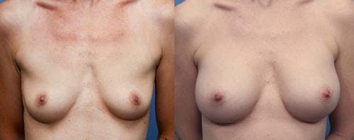 Breast Augmentation Before & After Gallery - Patient 58470479 - Image 1