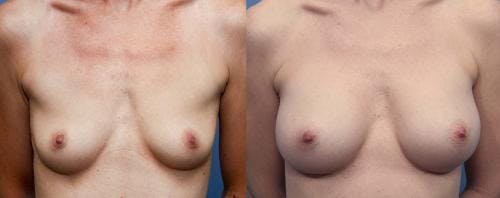Breast Augmentation Before & After Gallery - Patient 58470479 - Image 1