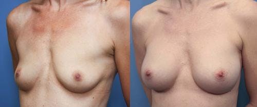 Breast Augmentation Before & After Gallery - Patient 58470479 - Image 2
