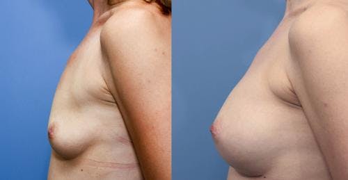 Breast Augmentation Before & After Gallery - Patient 58470479 - Image 3