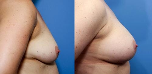 Breast Augmentation Before & After Gallery - Patient 58470480 - Image 2
