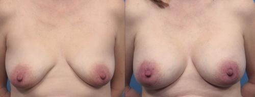 Breast Augmentation Before & After Gallery - Patient 58470482 - Image 1