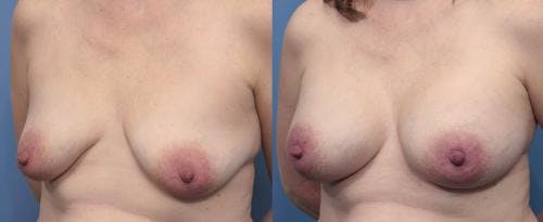 Breast Augmentation Before & After Gallery - Patient 58470482 - Image 2