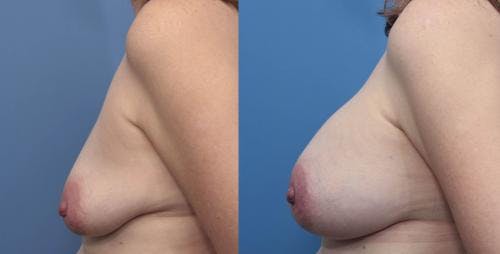 Breast Augmentation Before & After Gallery - Patient 58470482 - Image 3