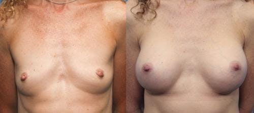 Breast Augmentation Before & After Gallery - Patient 58470483 - Image 1