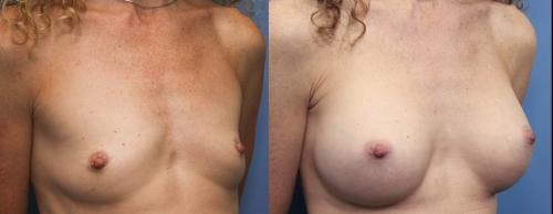 Breast Augmentation Before & After Gallery - Patient 58470483 - Image 2