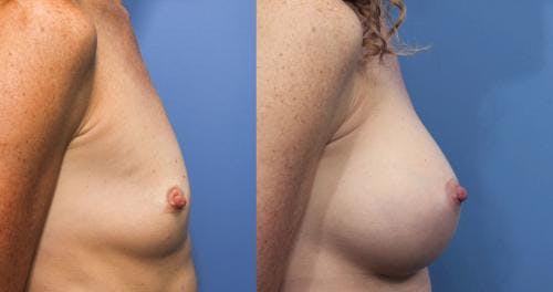 Breast Augmentation Before & After Gallery - Patient 58470483 - Image 3