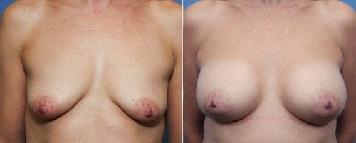 Breast Augmentation Before & After Gallery - Patient 58470485 - Image 1