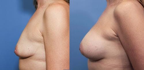 Breast Augmentation Before & After Gallery - Patient 58470485 - Image 2