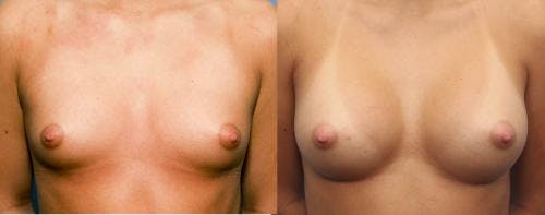 Breast Augmentation Before & After Gallery - Patient 58470487 - Image 1