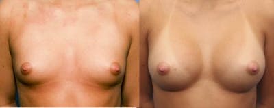 Breast Augmentation Before & After Gallery - Patient 58470487 - Image 1