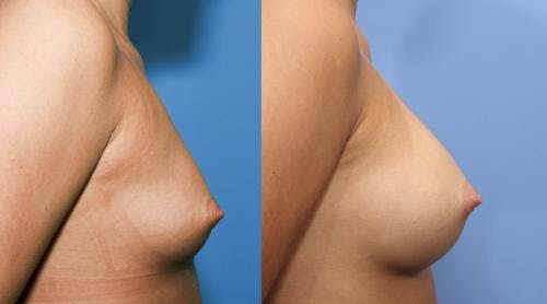 Breast Augmentation Before & After Gallery - Patient 58470487 - Image 2