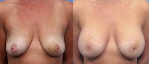 Breast Augmentation Before & After Gallery - Patient 58470488 - Image 1
