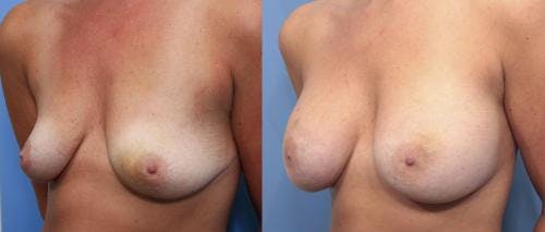 Breast Augmentation Gallery - Patient 58470488 - Image 2