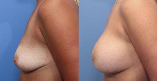 Breast Augmentation Before & After Gallery - Patient 58470488 - Image 3