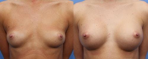 Breast Augmentation Before & After Gallery - Patient 58470489 - Image 1