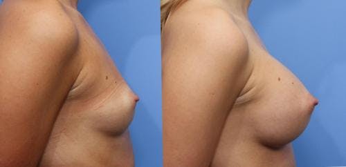 Breast Augmentation Before & After Gallery - Patient 58470489 - Image 2