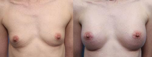 Breast Augmentation Before & After Gallery - Patient 58470490 - Image 1