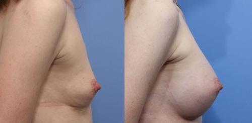 Breast Augmentation Before & After Gallery - Patient 58470490 - Image 2