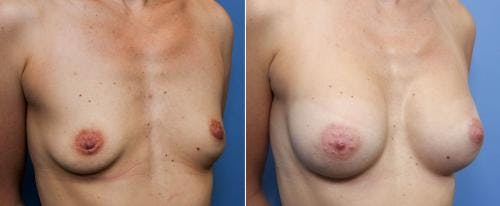 Breast Augmentation Before & After Gallery - Patient 58490376 - Image 2