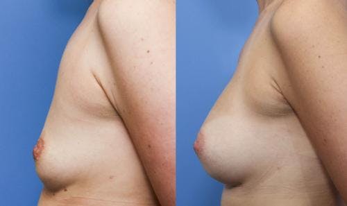 Breast Augmentation Before & After Gallery - Patient 58490376 - Image 3