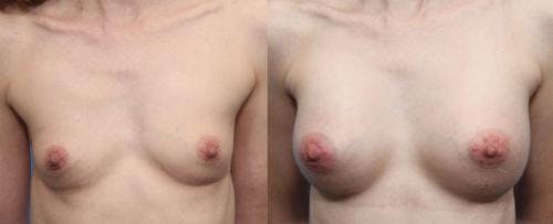 Breast Augmentation Before & After Gallery - Patient 58490377 - Image 1
