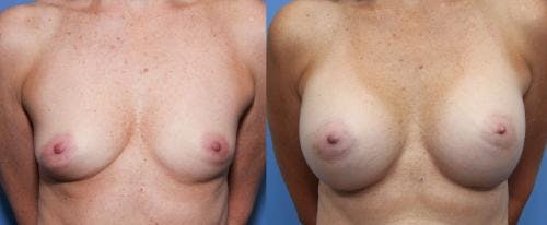 Breast Augmentation Before & After Gallery - Patient 58490378 - Image 1