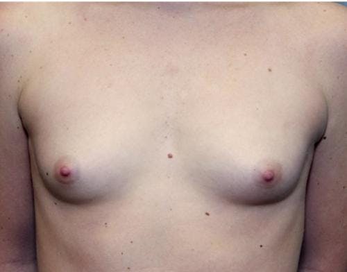 Breast Augmentation Before & After Gallery - Patient 58490379 - Image 1
