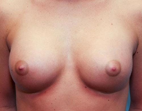 Breast Augmentation Before & After Gallery - Patient 58490379 - Image 2