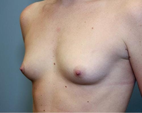 Breast Augmentation Before & After Gallery - Patient 58490379 - Image 3