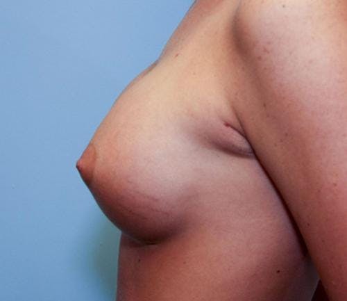 Breast Augmentation Gallery - Patient 58490379 - Image 6