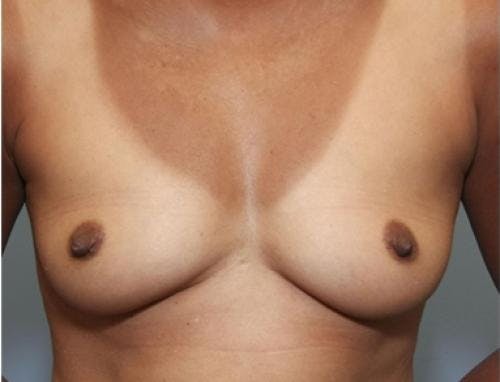 Breast Augmentation Before & After Gallery - Patient 58490380 - Image 1
