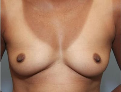 Breast Augmentation Before & After Gallery - Patient 58490380 - Image 1