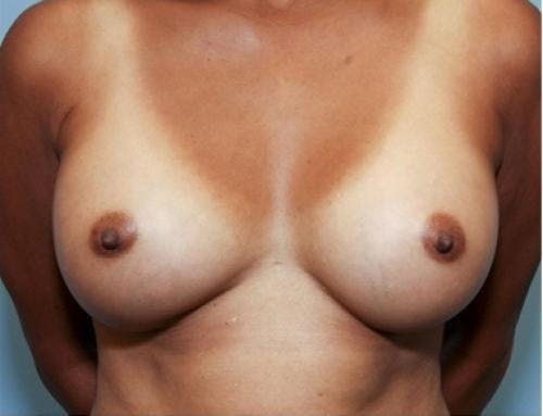 Breast Augmentation Before & After Gallery - Patient 58490380 - Image 2