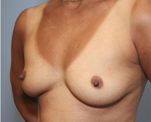 Breast Augmentation Before & After Gallery - Patient 58490380 - Image 3