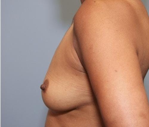 Breast Augmentation Before & After Gallery - Patient 58490380 - Image 5