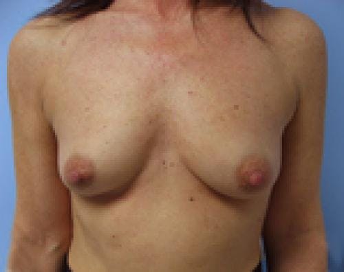 Breast Augmentation Before & After Gallery - Patient 58490390 - Image 1