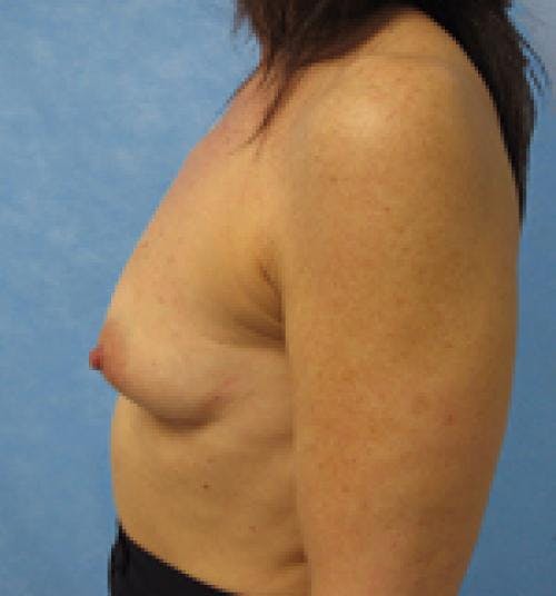 Breast Augmentation Before & After Gallery - Patient 58490390 - Image 3