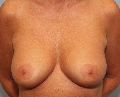 Breast Augmentation Before & After Gallery - Patient 58490391 - Image 2