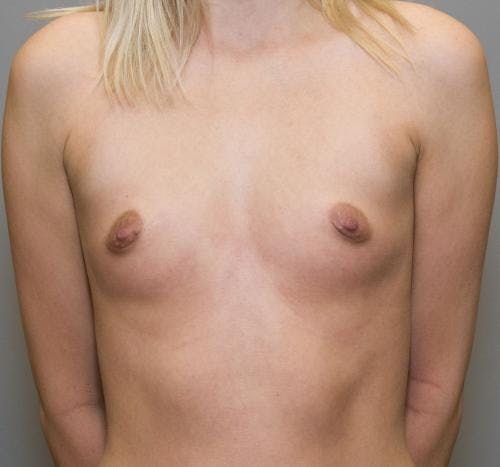 Breast Augmentation Before & After Gallery - Patient 58490392 - Image 1