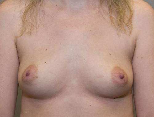 Breast Augmentation Before & After Gallery - Patient 58490393 - Image 1