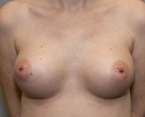 Breast Augmentation Before & After Gallery - Patient 58490393 - Image 2