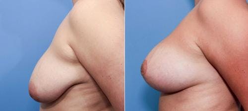 Breast Lift with Augmentation Before & After Gallery - Patient 58490410 - Image 3